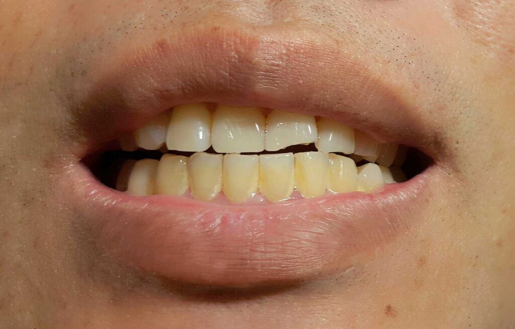 dental veneer advice